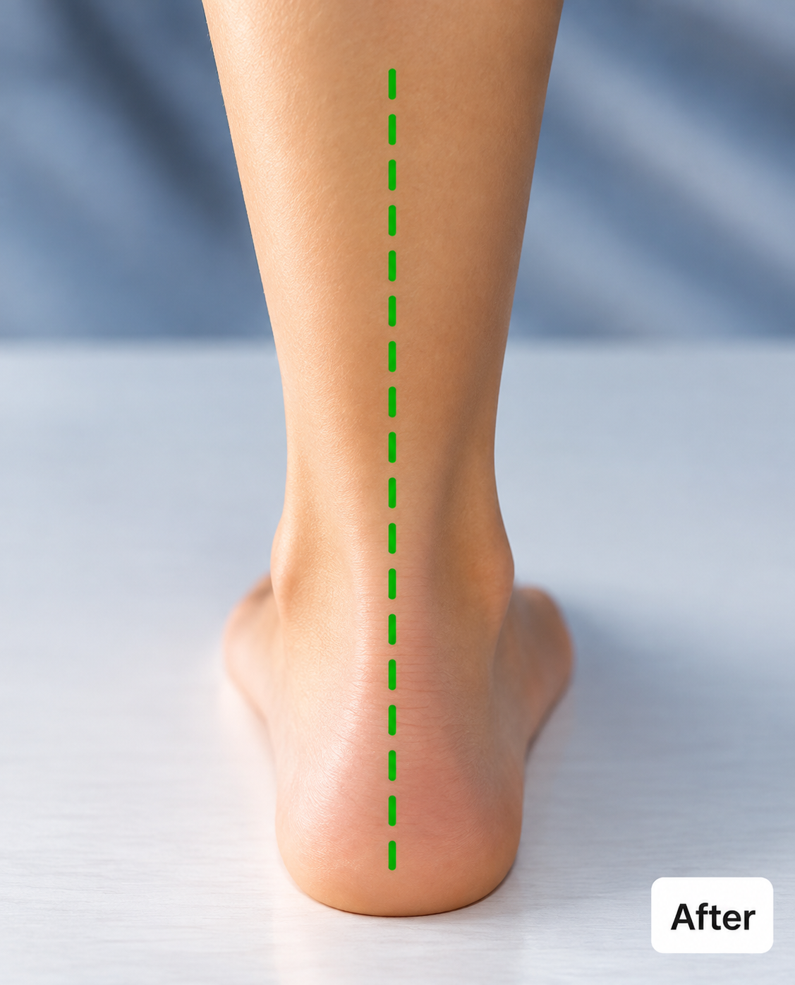Foot alignment with AltaFit insoles